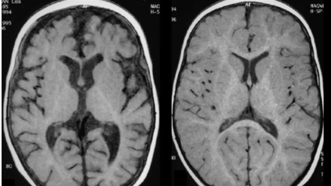  ایمنی و اثربخشی لوزارتان در کاهش آتروفی مغزی در بیماران مبتلا به آلزایمر
